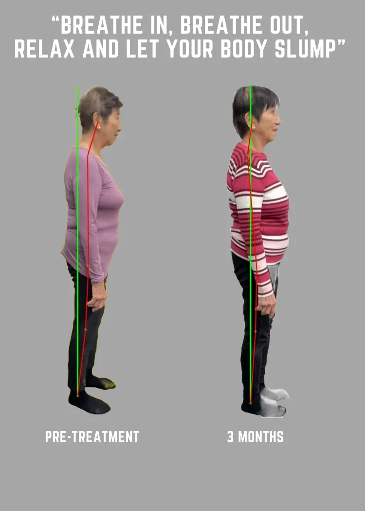 Postural change after several ABC™ treatments