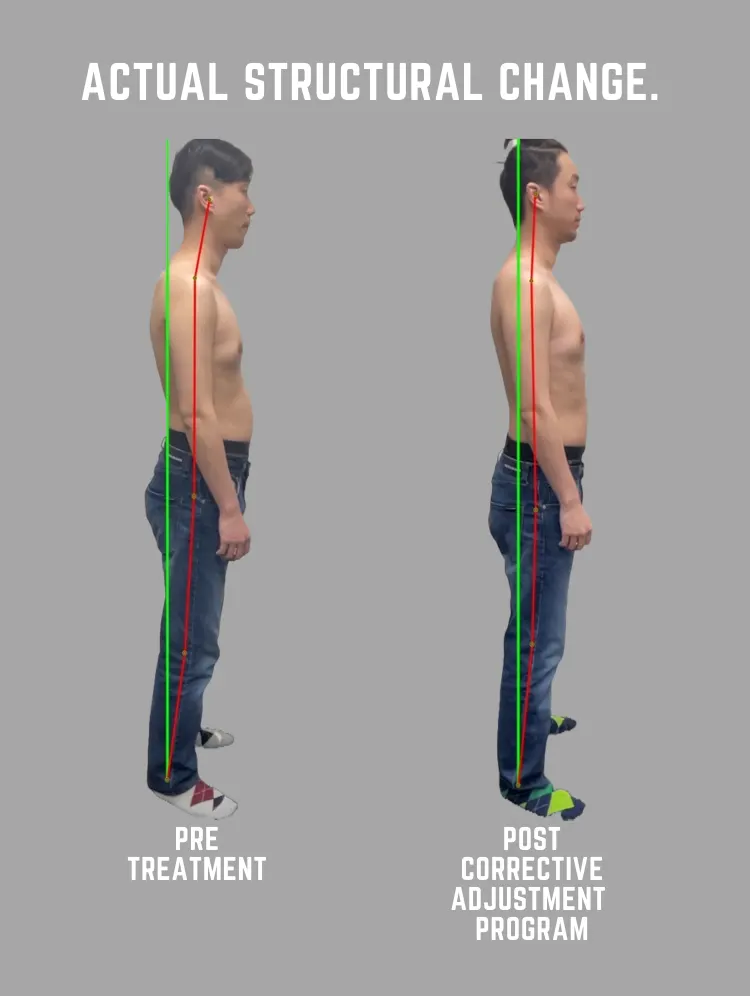 Postural change after several ABC™ treatments