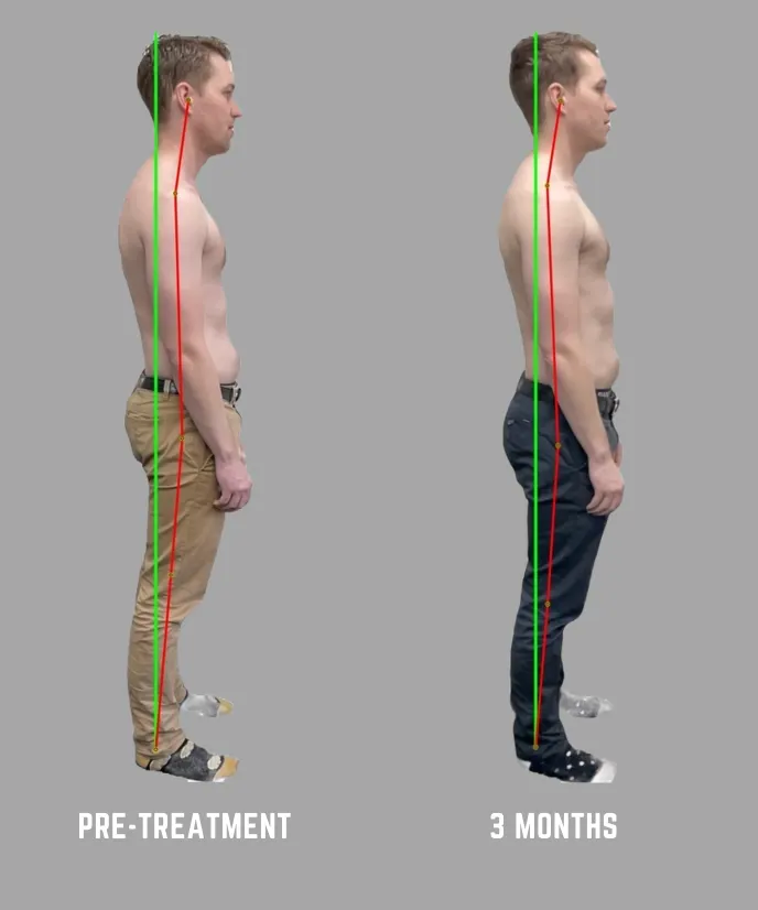 Postural change after several ABC™ treatments